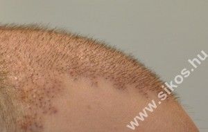 Hajátültetés, hajbeültetés, FUE, hajimplantáció, hajtranszplantáció, hajáthelyezés, graft, hajvonal, beültetés, implantáció